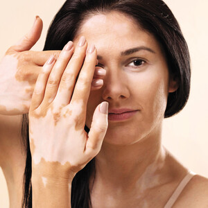 Αντιμετωπίζουμε τη λεύκη με τη βοήθεια του δερματολόγου