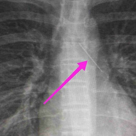 Θεσσαλονίκη: Ανήλικη κατάπιε καρφίτσα, σωτήρια επέμβαση από τους γιατρούς