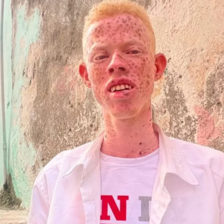 «Μου λένε ότι είμαι κανίβαλος, ότι θα φάω τα παιδιά τους»- Η εξομολόγηση ενός Σομαλού αλμπίνο