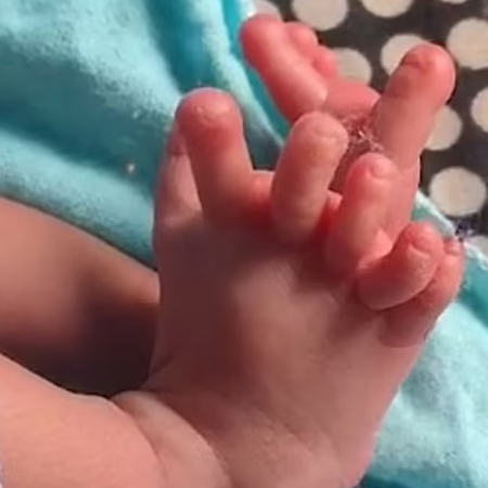 Μωρό στην Ινδία γεννήθηκε με 26 δάχτυλα και οι γονείς πιστεύουν πως είναι θεότητα 