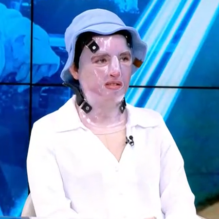 Πήγε να ανάψει την σόμπα και κάηκε - «Στην αρχή έδιναν 5% ελπίδες στην μητέρα μου για να ζήσω»