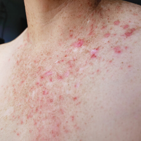 Οι επιστήμονες πιστεύουν ότι βρήκαν την ορμόνη που προκαλεί τη ψωρίαση