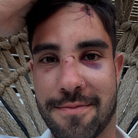 Ρόδος: Ομοφοβική επίθεση σε βάρος τουρίστα - Η ανάρτηση του θύματος μετά τον ξυλοδαρμό