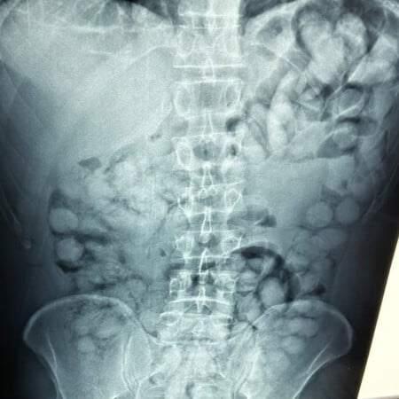 Συνελήφθη Βραζιλιάνος στο «Ελ. Βενιζέλος»: Είχε καταπιεί 100 «αυγουλάκια» κοκαΐνης