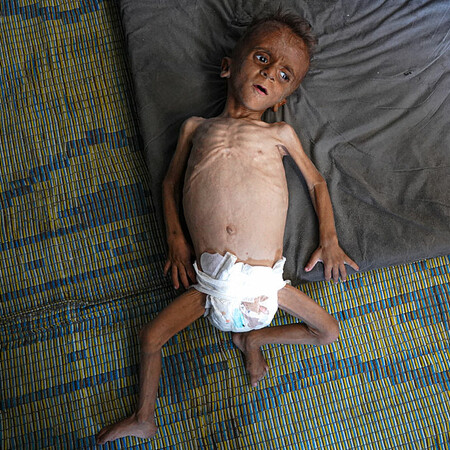 «Πολύ άρρωστοι και πολύ κουρασμένοι»: Η πραγματικότητα του λιμού στη Γάζα που το Ισραήλ αρνείται