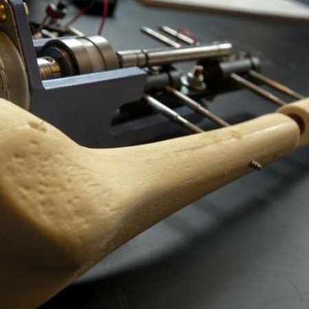 Επιμήκυνση ποδιών στην Τουρκία: Το νέο ακραίο trend της αισθητικής