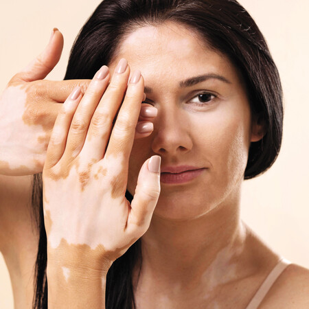 Αντιμετωπίζουμε τη λεύκη με τη βοήθεια του δερματολόγου