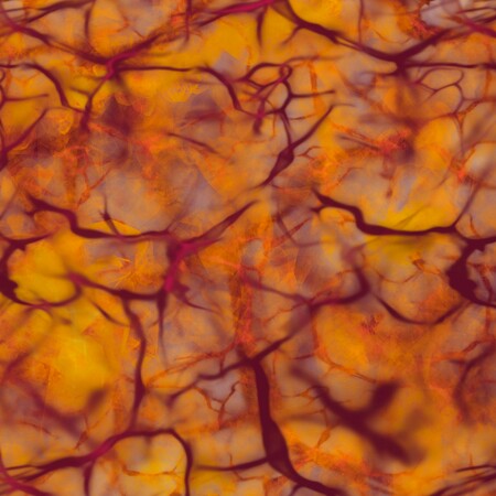 ΙΣΩΣ ΓΙΑ ΣΚ - Σκλήρυνση κατά πλάκας: Ανακαλύφθηκαν δύο υποτύποι με τη βοήθεια της τεχνητής νοημοσύνης 