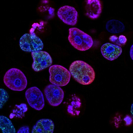 ΚΑΡΚΙΝΟΣ ΠΑΧΥ ΕΝΤΕΡΟ ΣΥΝΗΘΕΙΕΣ