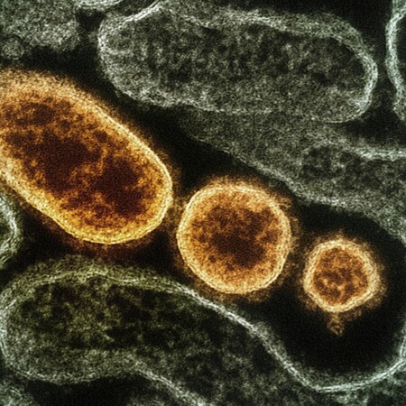 Γρίπη: Δεκάδες κρούσματα στα νοσοκομεία - Κυριαρχεί η υποπαραλλαγή Κ