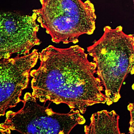 ΚΑΡΚΙΝΟΣ ΣΤΟ ΠΑΓΚΡΕΑΣ ΔΙΑΓΝΩΣΗ