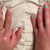 Όταν εκείνη έχασε το μικρό της δαχτυλάκι, εκείνος της προσέφερε το δικό του