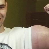 Η περίπτωση του Ρώσου «Ποπάυ» που κάνει ενέσεις με επικίνδυνα χημικά για να μεγαλώσει τα μπράτσα του