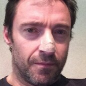 Με καρκίνο του δέρματος διαγνώστηκε ο Χιου Τζάκμαν