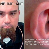 Αυτός ο τύπος έχει βάλει εμφύτευμα ακουστικού μέσα στο αυτί του!