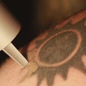 Δείτε από πολύ κοντά πώς αφαιρείται με λέιζερ ένα τατουάζ