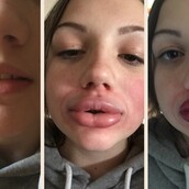 H νέα ιντερνετική τραγωδία της βεντούζας χειλιών 