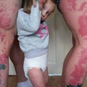 Oι γονείς που έκαναν τατουάζ τα σημάδια της κόρης τους για να μην νιώθει διαφορετική