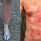 Τι θα συμβεί αν δεν απλώσεις το αντηλιακό σωστά