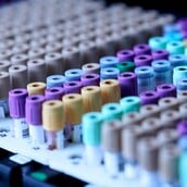 Πανεπιστήμιο Yale: Εξετάσεις αίματος θα μπορούσαν να προλάβουν υποτροπή του καρκίνου