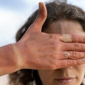 Ηλίαση: Συμπτώματα και τρόποι αντιμετώπισης