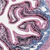 Κατανάλωση UPFs τροφίμων και καρκίνος του εντέρου: Τι δείχνει νέα μελέτη