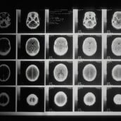 ΓΙΑ ΣΚ - Επιστήμονες ισχυρίζονται πως η παχυσαρκία μπορεί να επιταχύνει την εμφάνιση της νόσου Αλτσχάιμερ