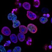 ΚΑΡΚΙΝΟΣ ΠΑΧΥ ΕΝΤΕΡΟ ΣΥΝΗΘΕΙΕΣ