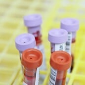 ΗΛΙΚΙΩΜΕΝΟΙ ΑΙΜΑΤΟΛΟΓΙΚΗ ΕΞΕΤΑΣΗ ΕΞΕΤΑΣΗ ΑΙΜΑΤΟΣ