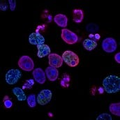 ΚΟΛΟΝΟΣΚΟΠΗΣΗ ΚΑΡΚΙΝΟΣ ΕΝΤΕΡΟ ΠΟΛΥΠΟΔΑΣ