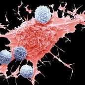 ΚΑΡΚΙΝΟΣ ΠΑΧΕΟΣ ΕΝΤΕΡΟΥ ΤΡΟΦΕΣ