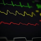 ΚΑΡΔΙΑ ΑΡΡΥΘΜΙΑ ΤΑΧΥΚΑΡΔΙΑ ΕΡΕΥΝΑ