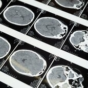 Τι είναι το ανεύρυσμα εγκεφάλου και πώς αναγνωρίζεται πριν από μια ρήξη;