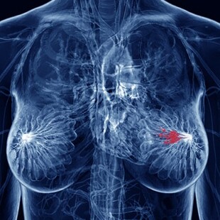 Το οικογενειακό ιστορικό καρκίνου στον μαστό αυξάνει τον κίνδυνο επιθετικών όγκων