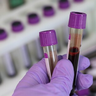 Έρευνα:Σχεδόν το 80% των ανθρώπων έχουν πλαστικά σωματίδια στο αίμα τους