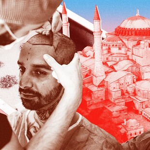 «Τουρισμός» για μεταμόσχευση μαλλιών στην Τουρκία: Μια τεράστια επιχείρηση