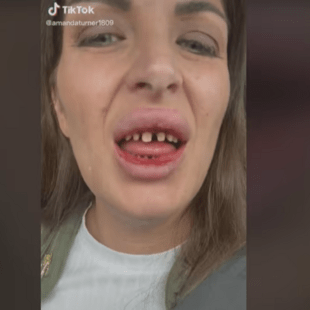 Explainer: Τι είναι τα TurkeyTeeth και τι συμβαίνει με τις φθηνές οδοντιατρικές επεμβάσεις στην Τουρκία;