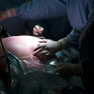 Η βαριατρική χειρουργική μειώνει σημαντικά τους πρόωρους θανάτους - Τα ευρήματα 40ετούς έρευνας 