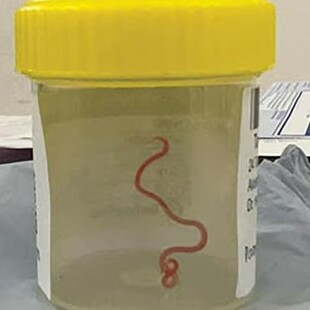 Ζωντανό σκουλήκι 8 εκατοστών βρέθηκε στον εγκέφαλο γυναίκας
