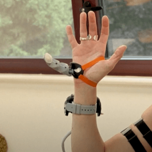 Επιστήμονες του Κέιμπριτζ δημιούργησαν λειτουργικό προσθετικό αντίχειρα για την ενίσχυση της παραγωγικότητας