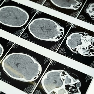 Μπορεί ένα ακουστικό εγκεφαλικής διέγερσης να αποτελεί λύση για την κατάθλιψη;