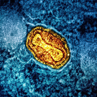 Νέα «πιο επιθετική παραλλαγή» mpox στην Ευρώπη - «Ανησυχητικό που υπάρχει ιστορικό ταξιδίου»