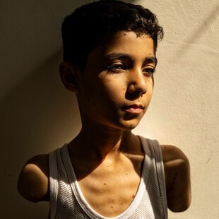 World Press Photo 2025: Πρώτο βραβείο στη φωτογραφία 9χρονου Παλαιστίνιου που ακρωτηριάστηκε