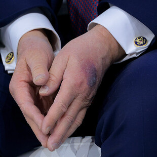 ΤΡΑΜΠ ΜΩΛΩΠΕΣ ΤΡΑΥΜΑΤΙΣΜΟΣ ΥΓΕΙΑ