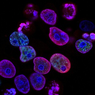 ΚΑΡΚΙΝΟΣ ΣΤΟ ΠΑΓΚΡΕΑΣ ΙΣΠΑΝΙΑ