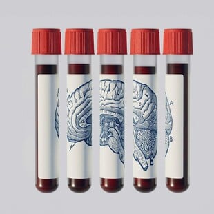 ΑΝΟΙΑ ΕΞΕΤΑΣΗ ΑΙΜΑΤΟΣ ΑΛΤΣΧΑΙΜΕΡ