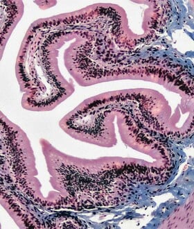 Κατανάλωση UPFs τροφίμων και καρκίνος του εντέρου: Τι δείχνει νέα μελέτη