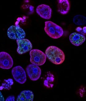 ΚΑΡΚΙΝΟΣ ΠΑΧΥ ΕΝΤΕΡΟ ΣΥΝΗΘΕΙΕΣ