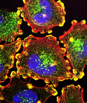 ΚΑΡΚΙΝΟΣ ΟΥΡΟΔΟΧΟΣ ΚΥΣΤΗ ΑΧΡΩΜΑΤΟΨΙΑ