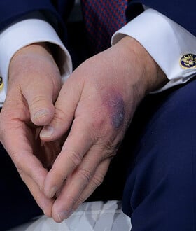 ΤΡΑΜΠ ΜΩΛΩΠΕΣ ΤΡΑΥΜΑΤΙΣΜΟΣ ΥΓΕΙΑ